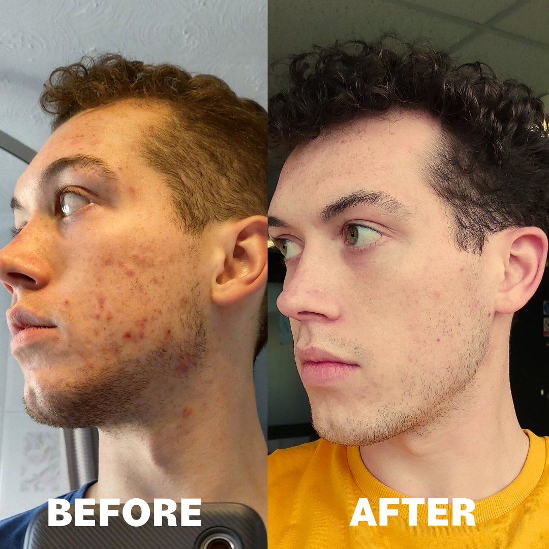 before and after acne supplement